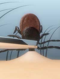 ticks Matches Burning Ticks Smothering